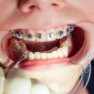 Ортодонт в Турции: фиксация брекет-системы