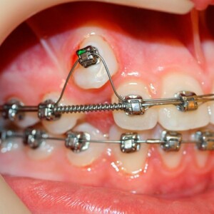 How braces work