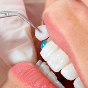 Installing veneers on teeth