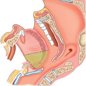 Глоссэктомия при раке языка
