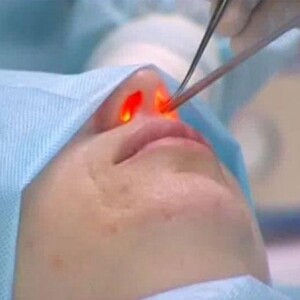 Laser rhinoplasty in Germany