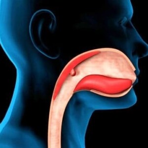 Орофарингеальный рак языка