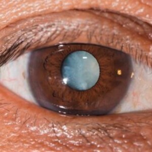 Симптомы глаукомы