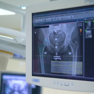 The use of computer navigation in hip replacement
