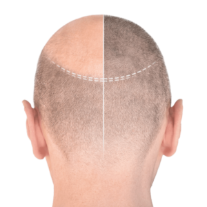 hair transplant at NovoMed clinic in Istanbul