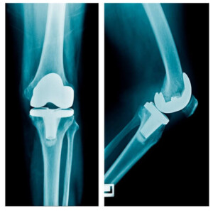 Endoprosthetics of the knee joint in Israel