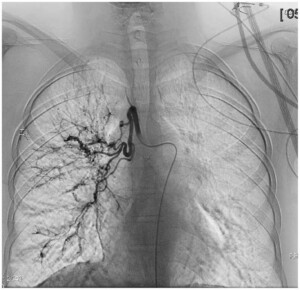 pulmonary embolization
