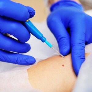 биопсия при раке кожи