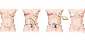 flap reconstruction of the breast