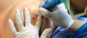 Reconstruction after mastectomy