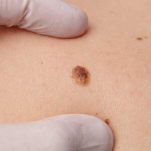 skin cancer treatment specialists