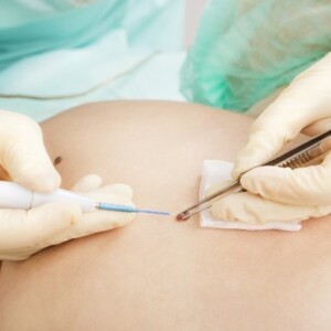 skin cancer treatment in Israel - surgery