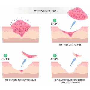 хирургия Мооса (Mohs).