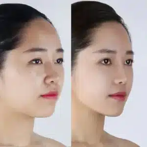 rhinoplasty in Korea