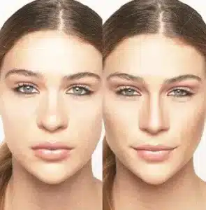 Rhinoplasty in Korea: patient reviews