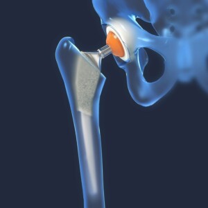 Treatment of the hip joint in Germany