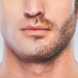 Вартість пересадки волосся на бороду в Туреччині