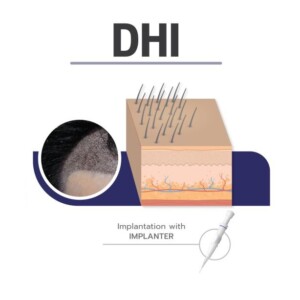 DHI method: Beard transplant in Turkey