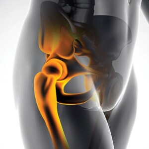 Treatment of the hip joint in Israel