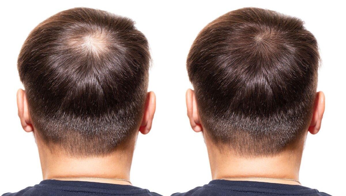 Який пакет із пересадки волосся в Туреччині краще вибрати: FUE чи DHI?