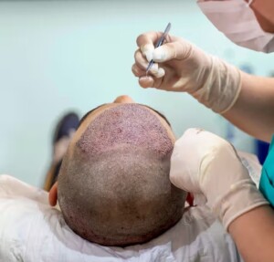 Hair transplant package in Turkey