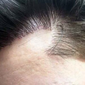 последствия неправильной пересадки волос