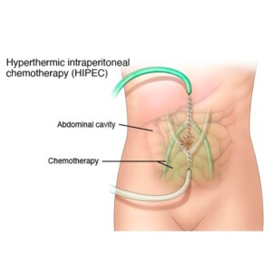HIPEC терапія раку шлунка
