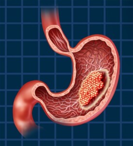 gastric cancer treatment abroad reviews