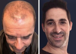 photos before and after hair transplantation