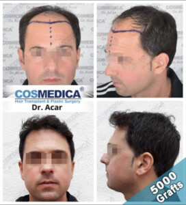 DHI трансплантация волос в Клинике Cosmedica (Космедика)
