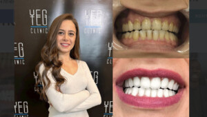 відбілювання зубів туреччина до і після