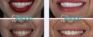 before and after photos of teeth whitening