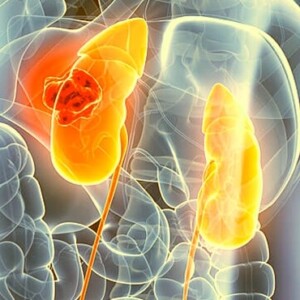 Methods of kidney cancer removal in Israel