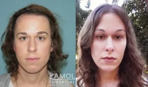 пластическая операция в Таиланде