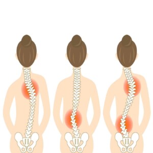 best therapy for scoliosis