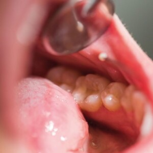 діагностика раку язика