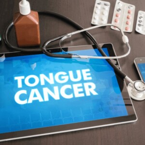 new treatments for tongue cancer