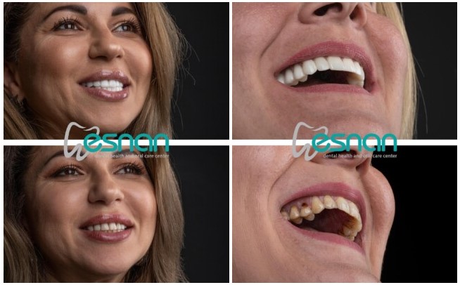 вініри для зубів у Туреччині до і після