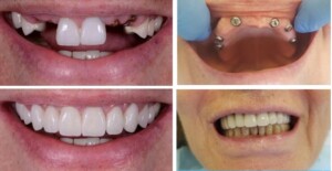 імплантація зубів all-on-6