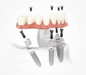cheapest country for all on 4 dental implants