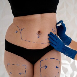 body sculpting after childbirth