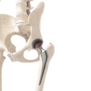 hip replacement surgery abroad