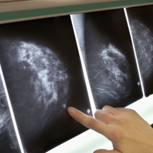 як виглядає рак грудей