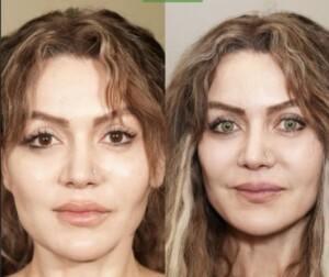 kerato antes y después