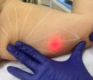 Thigh lift in Turkey with Endolift