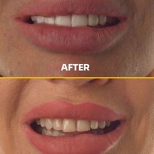 Costo de las carillas en Turquía