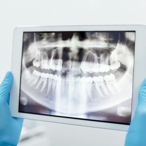 Carillas en Turquía