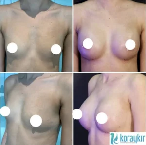 Precio de levantamiento de senos en Turquía