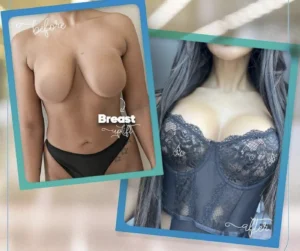 Procedimiento de levantamiento de senos