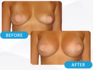 Levantamiento de busto en Turquía